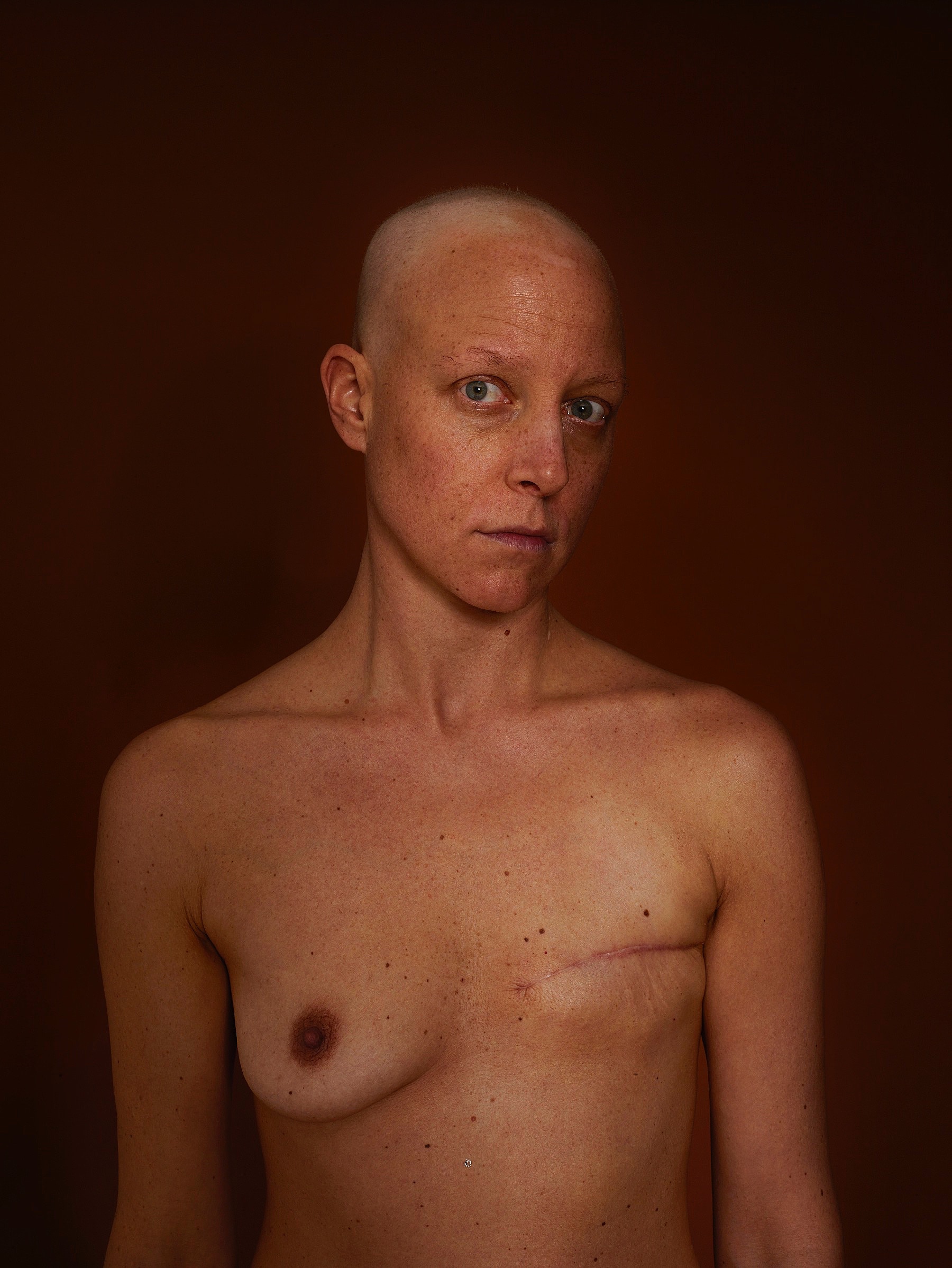 Caspar	Martig - Fuck the cancer - Felix Schoeller Photoaward